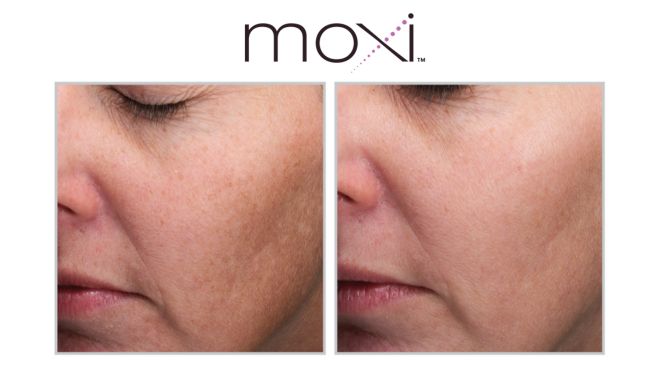 Moxi Before and After